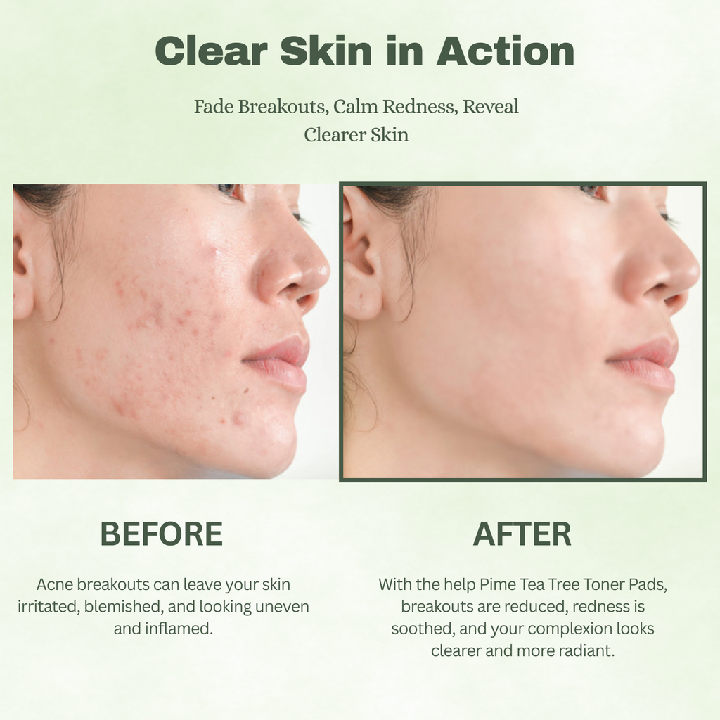 Tea Tree Toner Pads – 60 Sheets Soothing & Hydrating for Acne-Prone & Sensitive Skin, Pore-Cleansing