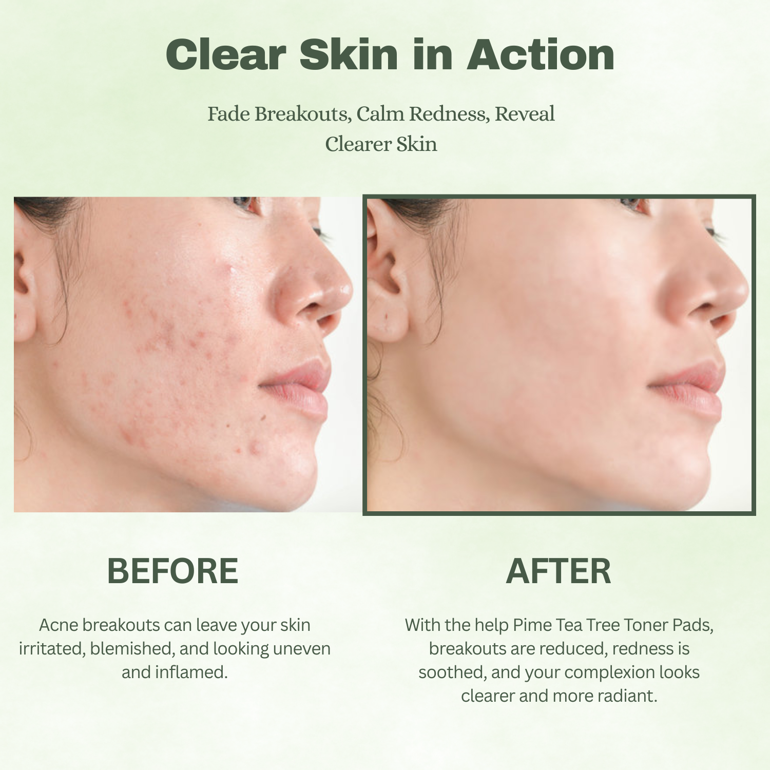 Tea Tree Toner Pads – 60 Sheets Soothing & Hydrating for Acne-Prone & Sensitive Skin, Pore-Cleansing