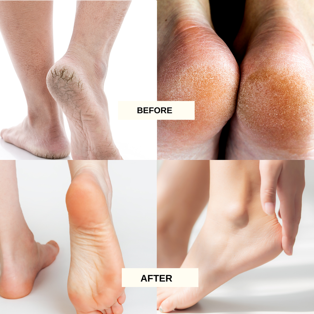 Moisturizing Foot Cream – Urea Infused for Repairing Cracked Heels & Dry Feet – Soft, Smooth Skin – 100g